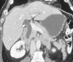 3D of Dilated Common Bile Duct Due to Distal Cancer - CTisus CT Scan