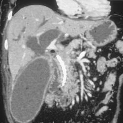 Pancreatic Cancer With Portal Vein Encasement. Courvesier Gallbladder Also Seen. - CTisus CT Scan