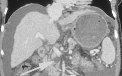 Incidental Cystadenoma in Patient With Cirrhosis - CTisus CT Scan