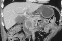 Pancreatic Cancer Encases the Portal Vein - CTisus CT Scan