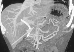 Collaterals Due to Encasement of the Portal Vein By Pancreatic Cancer - CTisus CT Scan