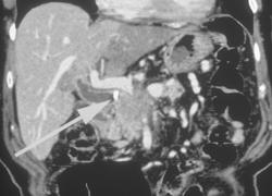 Pancreatic Cancer Encases Portal Vein Confluence With Collaterals - CTisus CT Scan