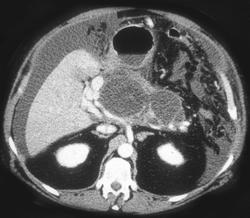 Carcinomatosis With Metastases to the Pancreas in Patient With Pseudomyxoma Peritonei (PMP) - CTisus CT Scan