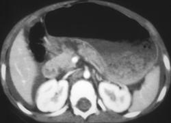 Laceration of the Pancreas (trauma) - CTisus CT Scan