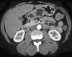 Nice Superior Mesenteric Vein (SMV) on Arterial and Venous Phase. Pseudo clot Seen on Arterial Phase - CTisus CT Scan