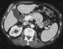 Renal Cell Cancer Metastatic to the Pancreas - CTisus CT Scan