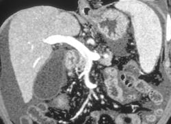 Flow Changes in Portal Vein on Arterial Phase Images With Normal Portal Vein on Venous Phase - CTisus CT Scan