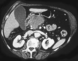 Pancreatic Cancer - CTisus CT Scan