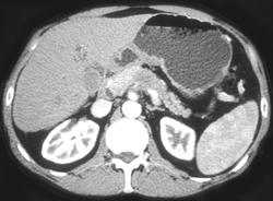 Cancer of the Body of the Pancreas - CTisus CT Scan