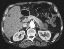 Pancreatic Cancer (tail) Invades the Splenic Vein - CTisus CT Scan