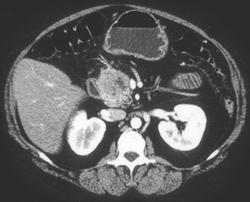 Pancreatic Cancer (Head of Pancreas) - CTisus CT Scan