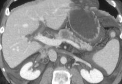 Carcinoma of the Body of the Pancreas - CTisus CT Scan