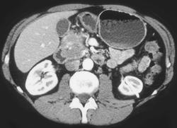 Pancreatic Head Carcinoma - CTisus CT Scan