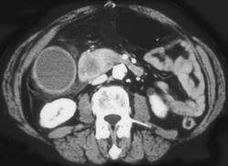 Metastatic Melanoma to the Pancreas - CTisus CT Scan