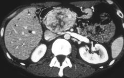 Islet Cell Carcinoma of the Pancreas - CTisus CT Scan