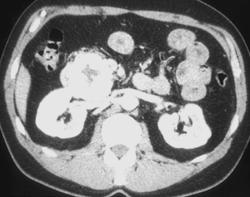 Glucagonoma - CTisus CT Scan