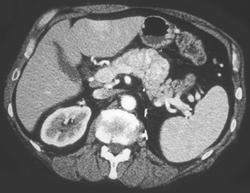 Metastatic Renal Cell Cancer to the Pancreas - CTisus CT Scan