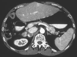 Hepatoma Metastatic to the Tail of the Pancreas - CTisus CT Scan