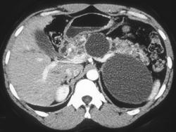 Pancreatic Cyst in Patient With Von-hippel Lindau Syndrome - CTisus CT Scan