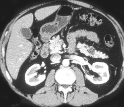 Intraductal Papillary Mucinous Tumor (IPMT) of the Pancreatic Tail - CTisus CT Scan