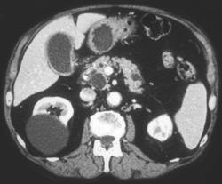 2 Intraductal Papillary Mucinous Tumors (IPMTs) of the Pancreas - CTisus CT Scan