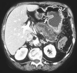 Intraductal Papillary Mucinous Tumor of the Pancreas Replaces the Entire Gland - CTisus CT Scan