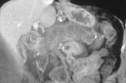 3D of Intraductal Papillary Mucinous Tumor (IPMT) - CTisus CT Scan