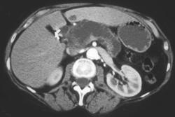 Super Intraductal Papillary Mucinous Tumor (IPMT) - CTisus CT Scan