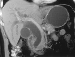 Dilated Common Bile Duct Due to Ampullary Cancer - CTisus CT Scan