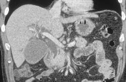 Encasement of Distal Common Bile Duct - CTisus CT Scan