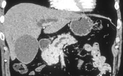 Top of Normal Pancreatic Head - CTisus CT Scan