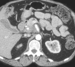 Pancreatic Cancer With SMA Encasement - CTisus CT Scan