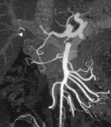 Normal Celiac and SMA Anatomy - CTisus CT Scan