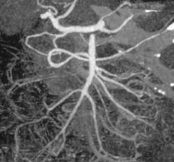 Pretty SMA Anatomy - CTisus CT Scan