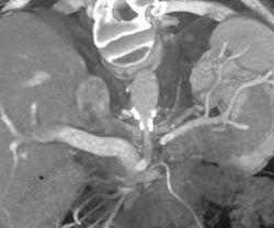 Stenosis of Celiac Axis - CTisus CT Scan