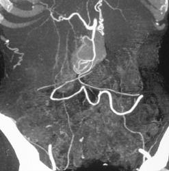 Normal Gastroduodenal Artery - CTisus CT Scan