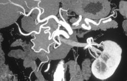 Normal Vascular Arcade of the Pancreas - CTisus CT Scan