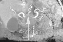 Pancreatic Cancer Encases the Celiac Axis With Liver Metastases - CTisus CT Scan