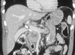 Pancreatic Cancer Abuts the Portal Vein - CTisus CT Scan