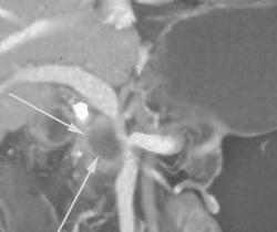 2 Cm Pancreatic Cancer Encases the Portal Vein and Superior Mesenteric Vein (SMV) Confluence - CTisus CT Scan