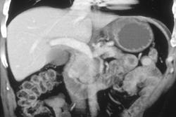 Carcinoma of the Pancreas Invades the Portal Vein - CTisus CT Scan