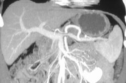 Pancreatic Cancer Encasing the Splenic Vein - CTisus CT Scan