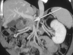 Pancreatic Cancer Encasing the Portal Vein - CTisus CT Scan