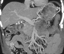 Carcinoma of the Pancreas With Collaterals Due to Vessel Invasion - CTisus CT Scan