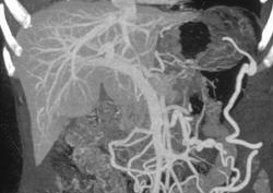 Carcinoma of the Pancreas Invades & Occludes the Splenic Vein - CTisus CT Scan