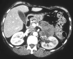 Pancreatic Cancer Invades the Splenic Vein & Renal Artery & Vein - CTisus CT Scan