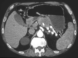 Pancreatic Cancer Invades the Splenic Artery - CTisus CT Scan