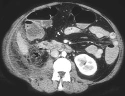 Acute Pancreatitis With Perirenal Inflammation Following An ERCP - CTisus CT Scan