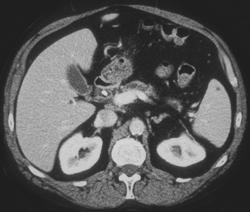 Pancreatic Cancer With Dilated Pancreatic Duct - CTisus CT Scan