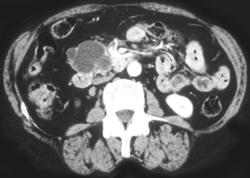 Cystadenoma of the Pancreas - CTisus CT Scan